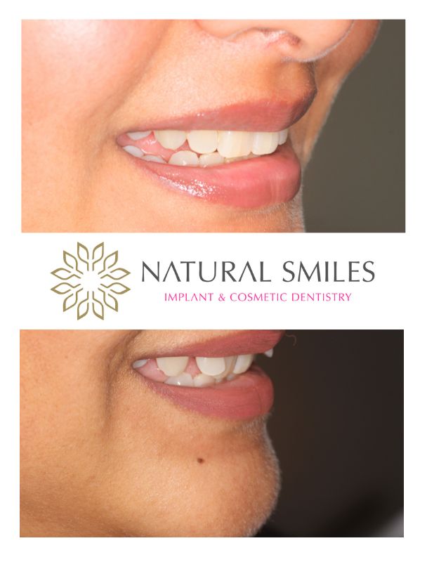 Cosmetic Dentist Invisialign Leicester and Corby
