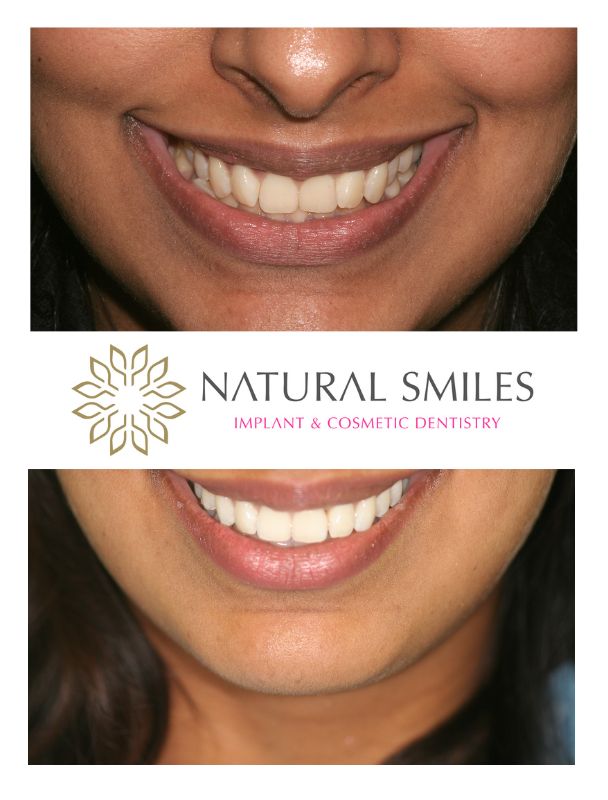 Cosmetic Dentist Leicester and Corby Braces