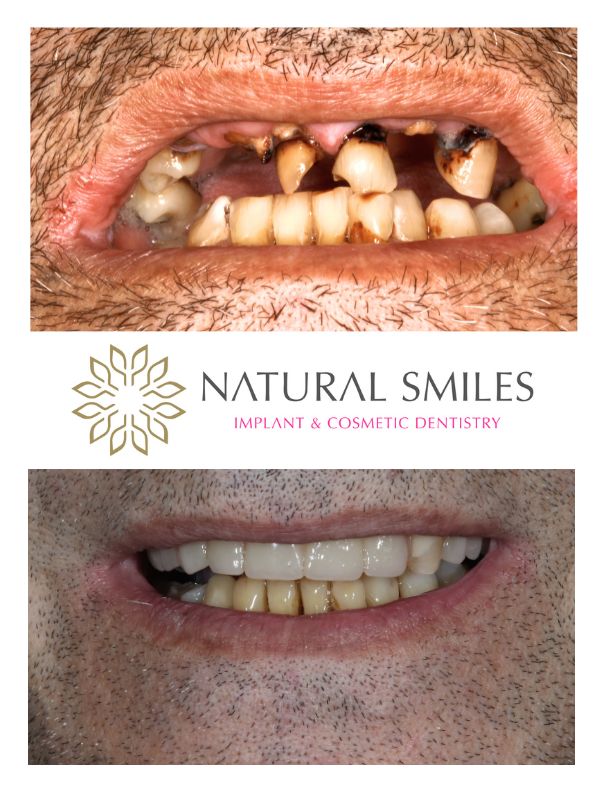 Cosmetic Dentist Leicester and Corby Chrome Denture