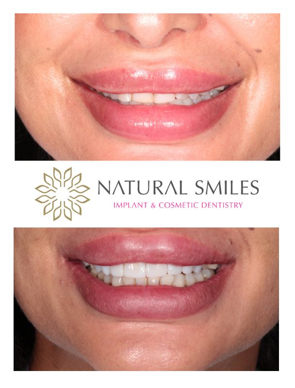 Cosmetic Dentist Leicester and Corby Composite bonding 10 teeth 1a