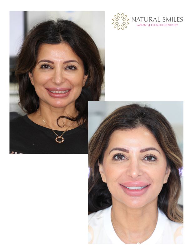 Cosmetic Dentist Leicester and Corby Composite bonding 10 teeth 1b