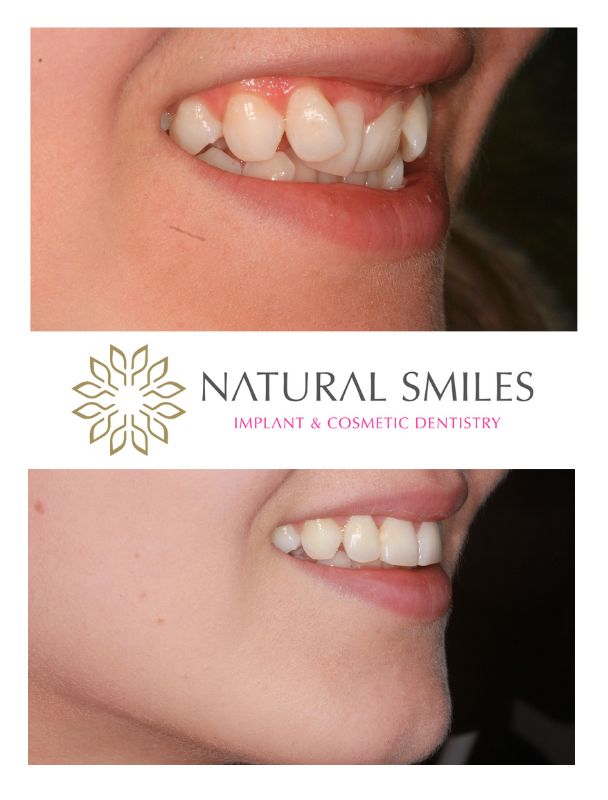 Cosmetic Dentist Leicester and Corby Fixed braces