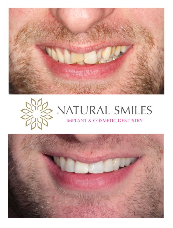 Cosmetic Dentist Leicester and Corby Fixed braces 2
