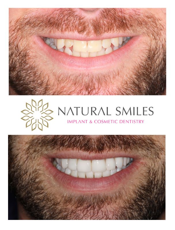 Cosmetic Dentist Leicester and Corby Invisalign and Porcelain Veneers