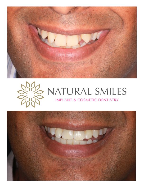 Cosmetic Dentist Leicester and Corby Invisalign and bonding
