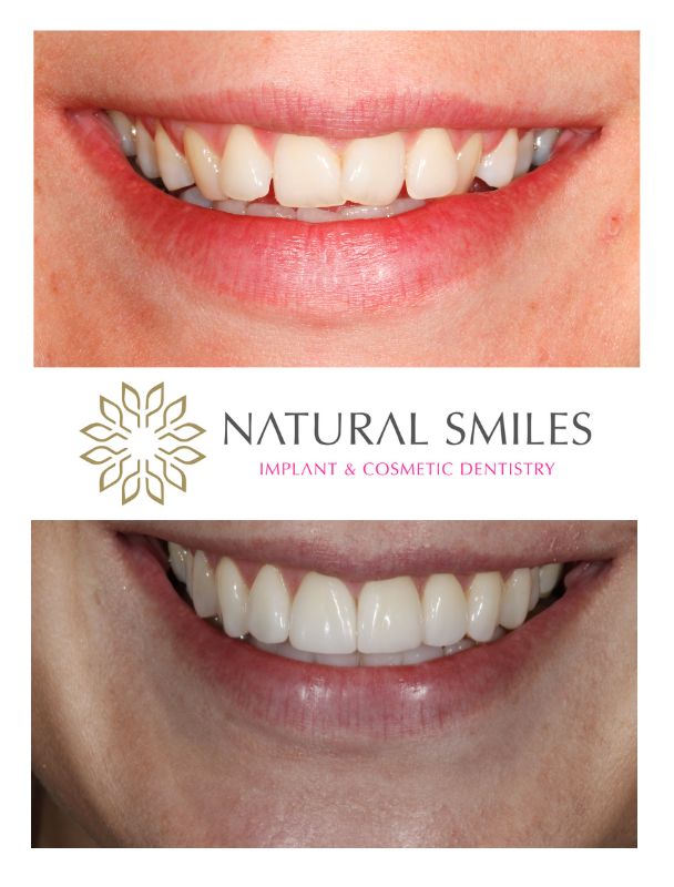 Cosmetic Dentist Leicester and Corby, Invisalign and veneers