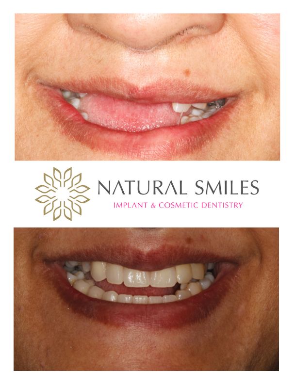 Cosmetic Dentist Leicester and Corby Partial dentures