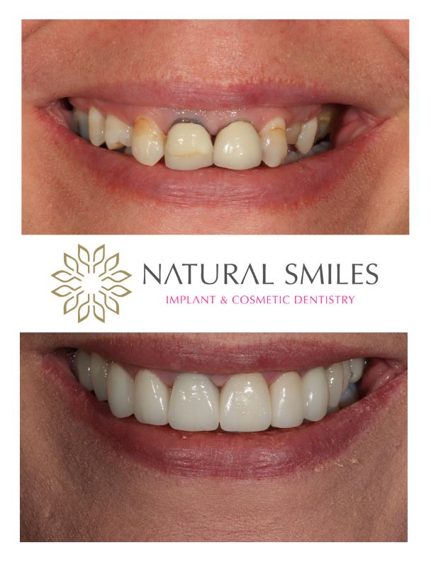 Cosmetic Dentist Leicester and Corby Porcelain veneers and Dental implants 3