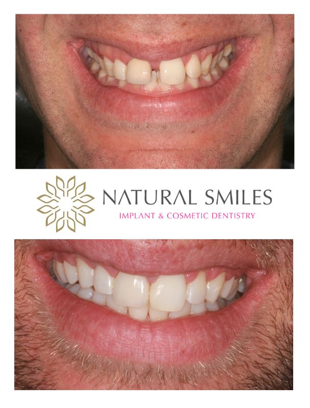Cosmetic Dentist Leicester and Corby, braces and veneers