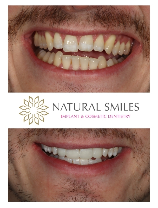 Cosmetic Dentist Leicester and Corby composite bonding