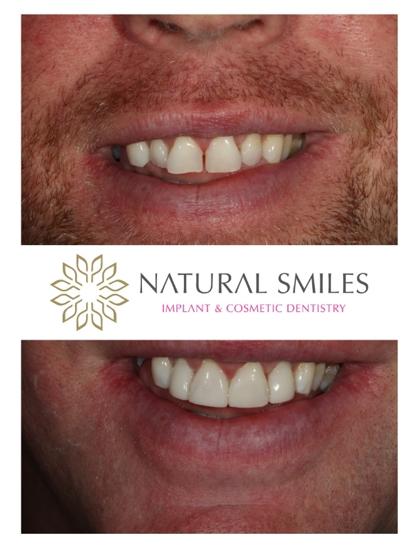 Cosmetic Dentist Leicester and Corby composite bondings