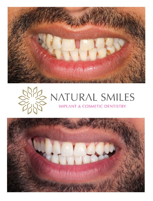 Cosmetic Dentist Leicester and Corby - invisalign