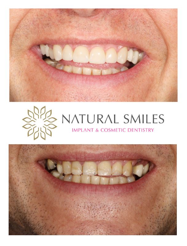 Cosmetic Dentist Leicester and Corby veneers and Dental Implants