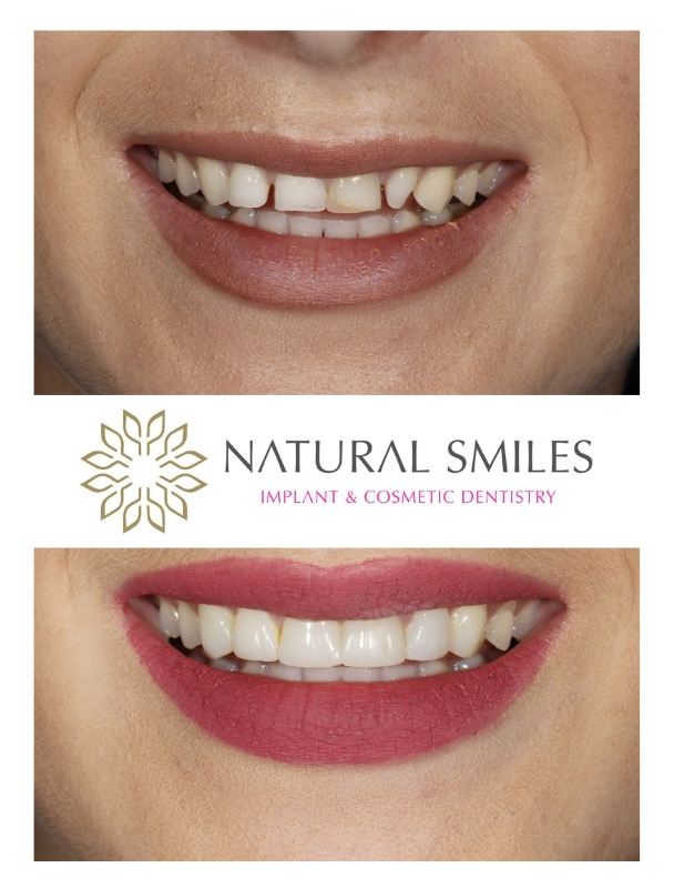Cosmetic Dentistry Composite Bonding Leicester and Corby