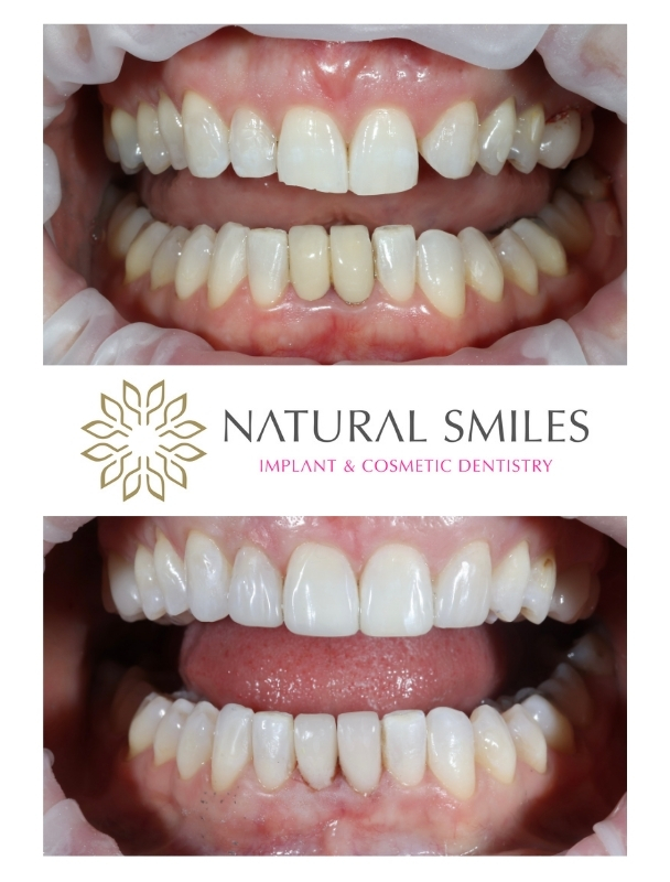 Cosmetic Dentistry Crowns and Composite Bonding 1a