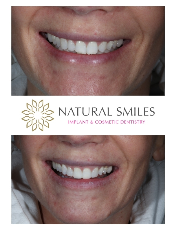 Cosmetic Dentistry Crowns and Composite Bonding 1b