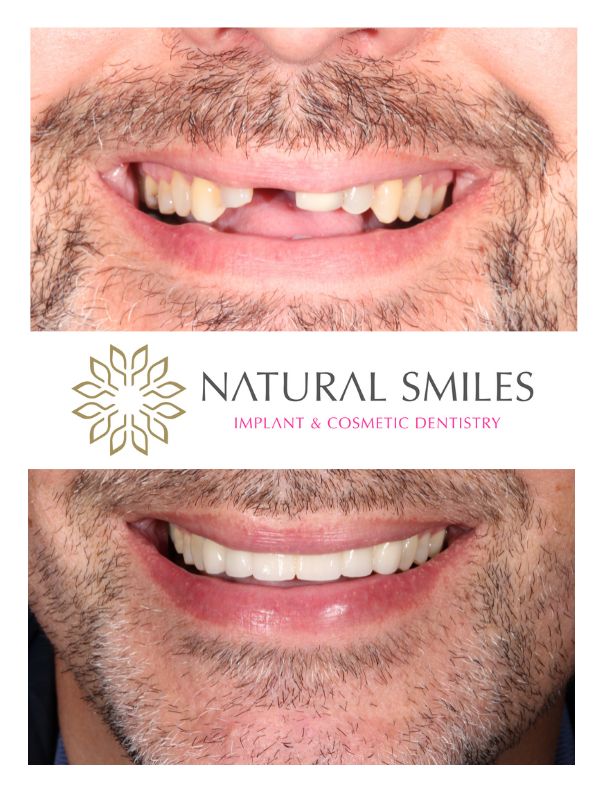 Cosmetic Dentistry Dental bridge Veneers Leicester and Corby