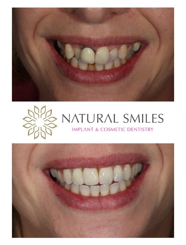 Cosmetic Dentistry, Invisalign and Dental implant Leicester and Corby