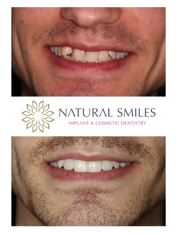 Cosmetic Dentistry Invisalign and bonding Leicester and Corby