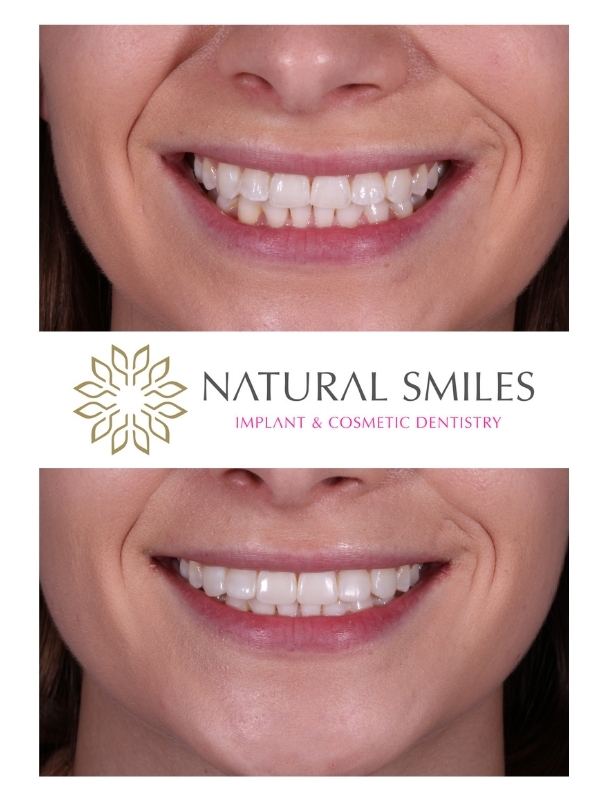 Cosmetic Dentistry Leicester and Corby Composite Bonding -subtle