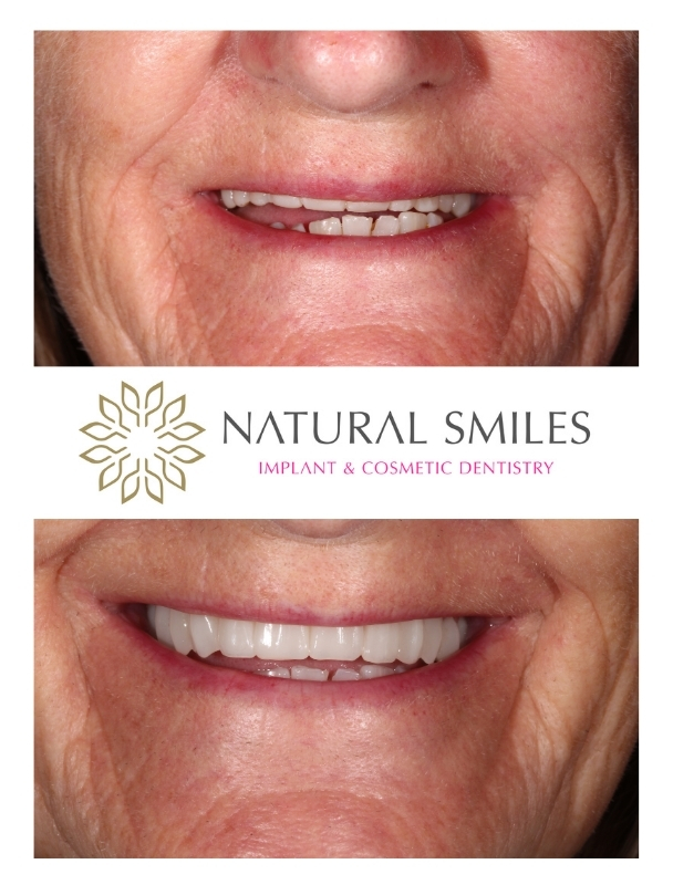 Cosmetic Dentistry Leicester and Corby Denture