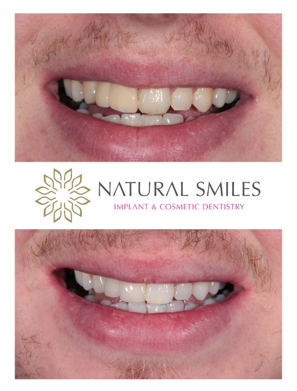 Cosmetic Dentistry Leicester and Corby New bridge