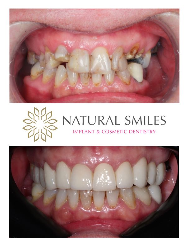 Cosmetic Dentistry Veneers and implants smile Leicester and Corby 1