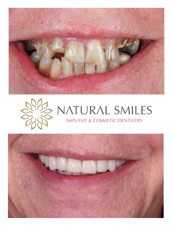 Cosmetic Dentistry Veneers and implants smile Leicester and Corby