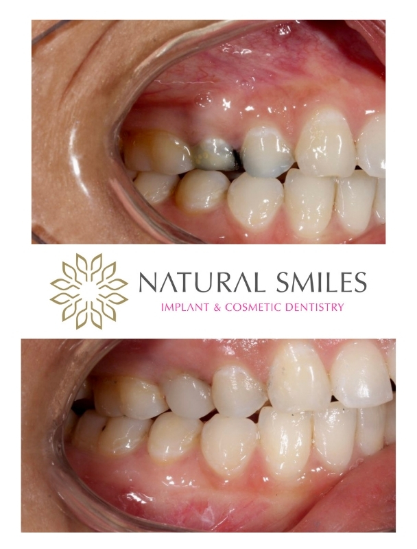 Cosmetic Dentistry crowns Leicester and Corby