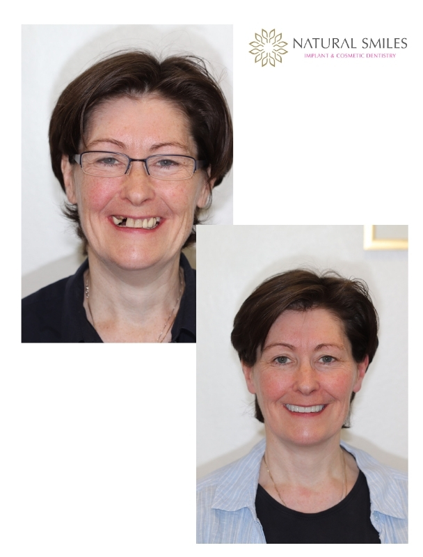 Cosmetic Dentisty Leicester and Corby Veneers and Implants SS face