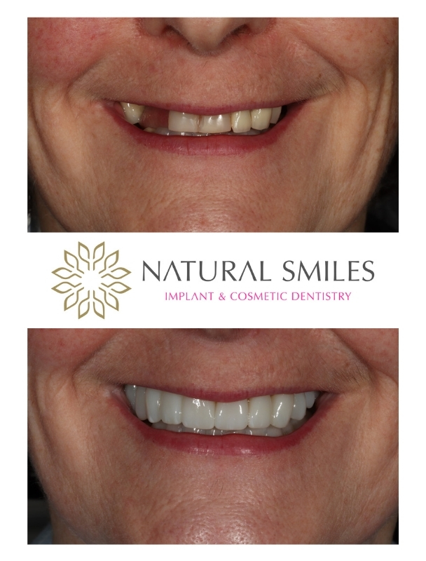 Cosmetic Dentisty Leicester and Corby Veneers and Implants SS smile