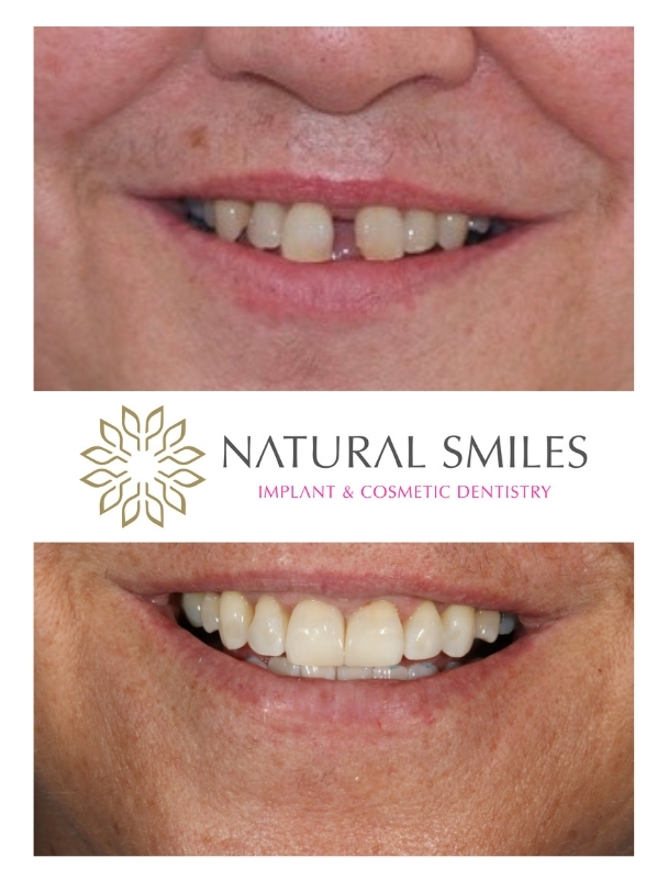 Invisalign and Bonding Leicester and Corby