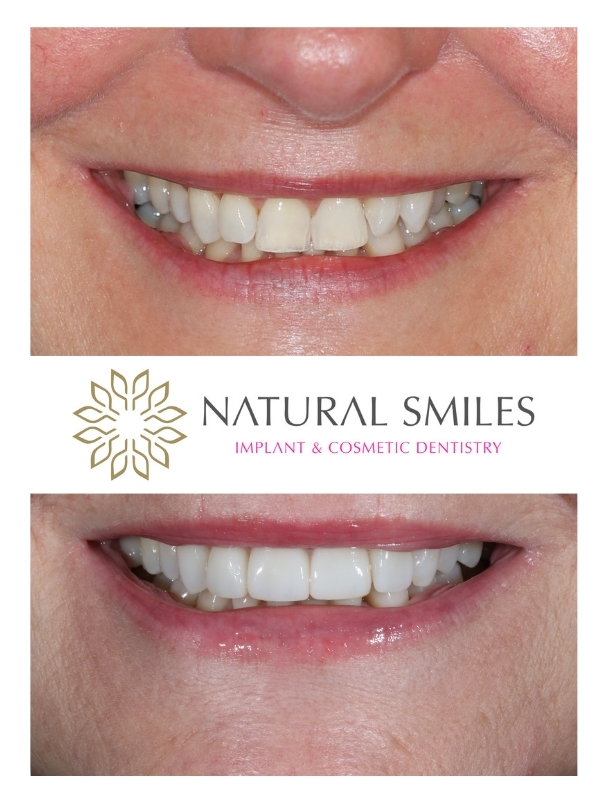 Invisalign and Veneers Corby and Leicester