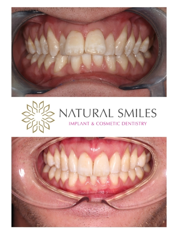 Invisalign complex Leicester and Corby
