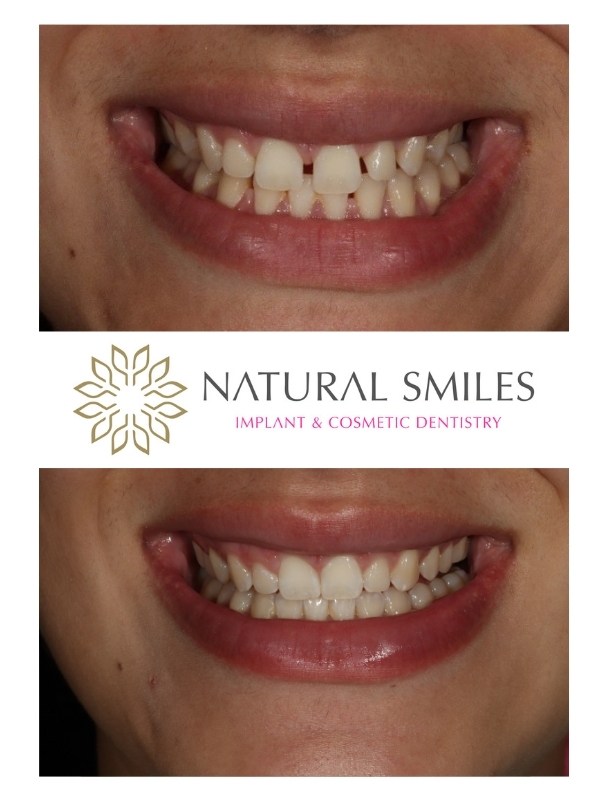 Invisalign gap closure Leicester and Corby 1a