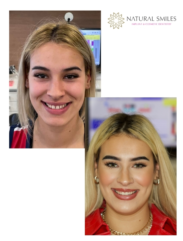 Invisalign gap closure Leicester and Corby 1b