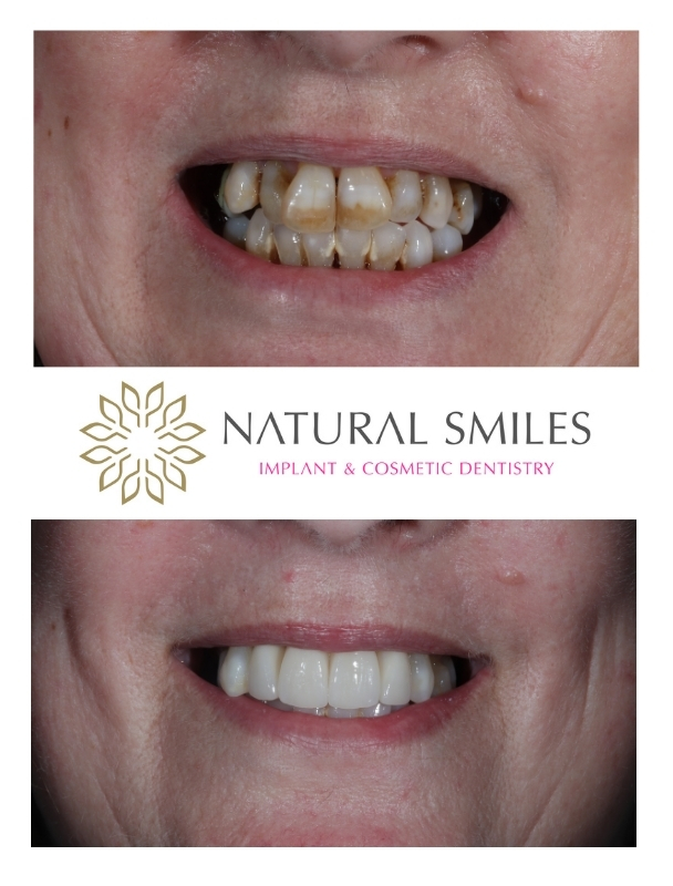 Porcelain Veneers Corby and Leicester 1