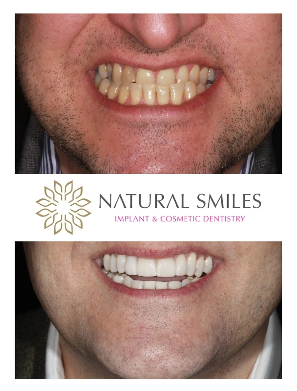 Porcelain Veneers Corby and Leicester
