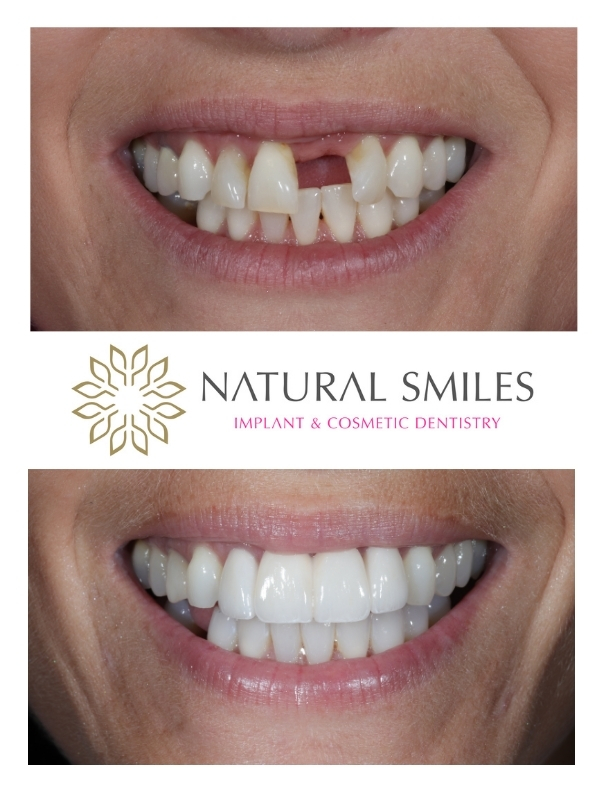 Porcelain bridge and Veneer Leicester and Corby 1