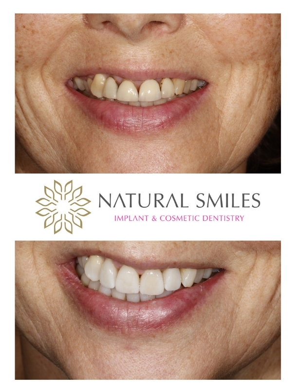 Porcelain veneers Leicester and Corby